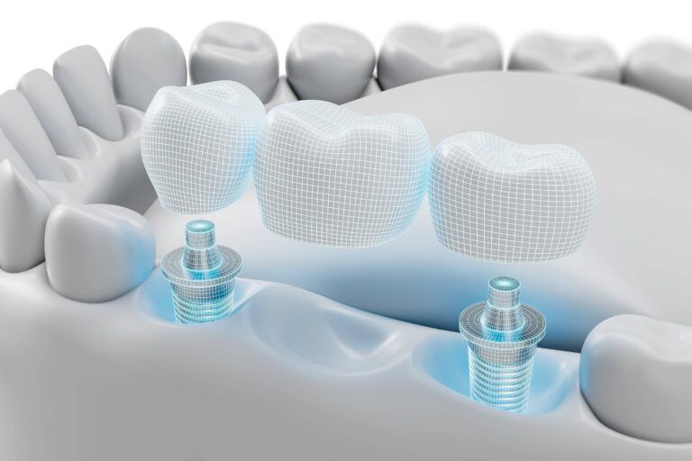 Dental implant bridge structure with 3D modeled artificial teeth and abutments