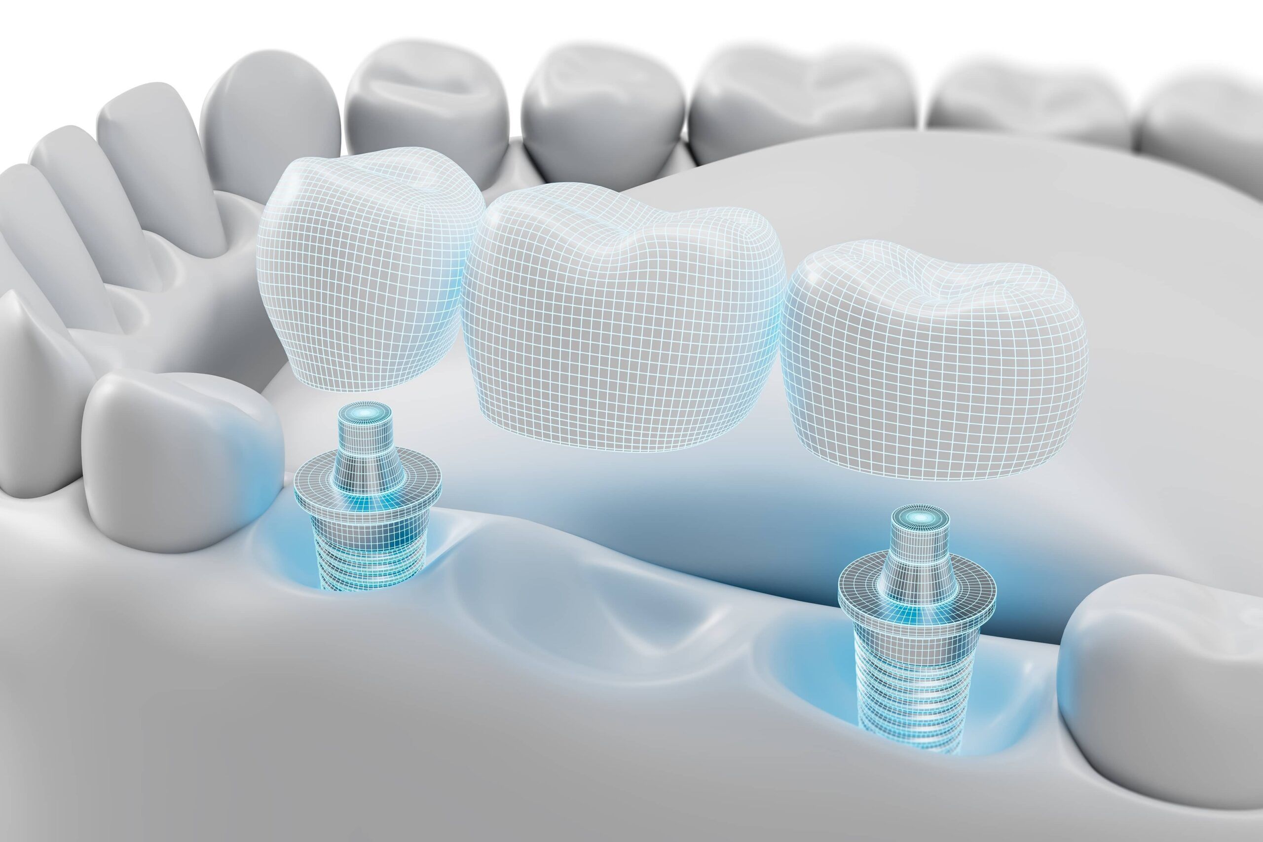 Dental implant bridge structure with 3D modeled artificial teeth and abutments
