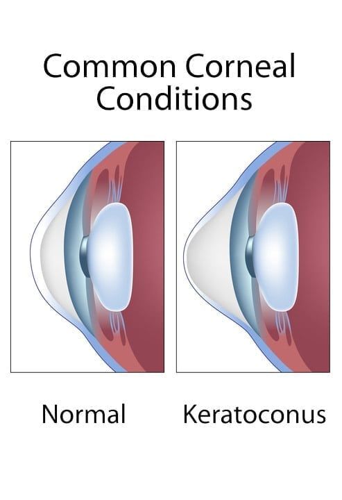 Keratoconus