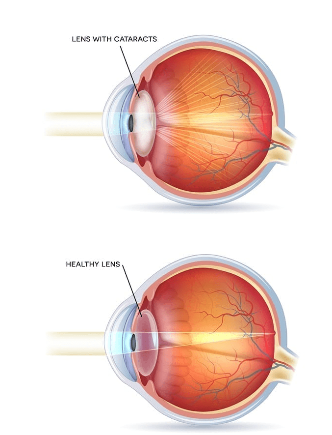 image illustrates the difference between a healthy human eye lens and one with a cataract.