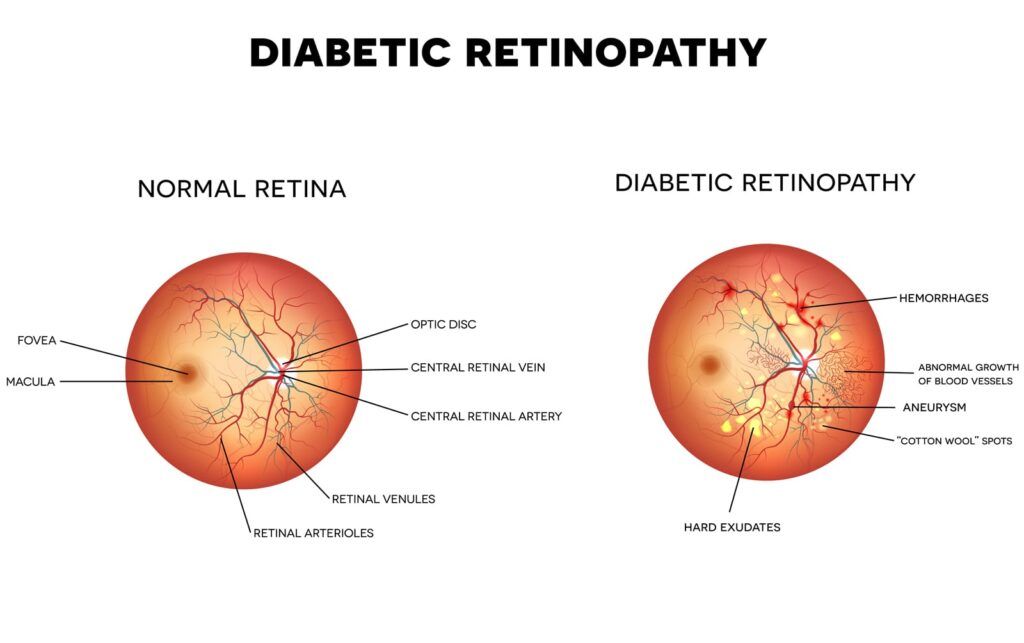 Diabetic Eye Disease Screenings