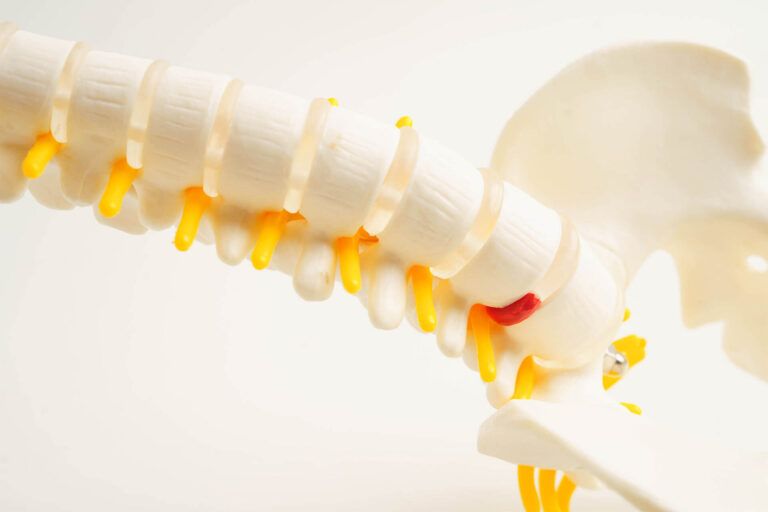 Spinal nerve and bone, Lumbar spine displaced herniated disc fragment,