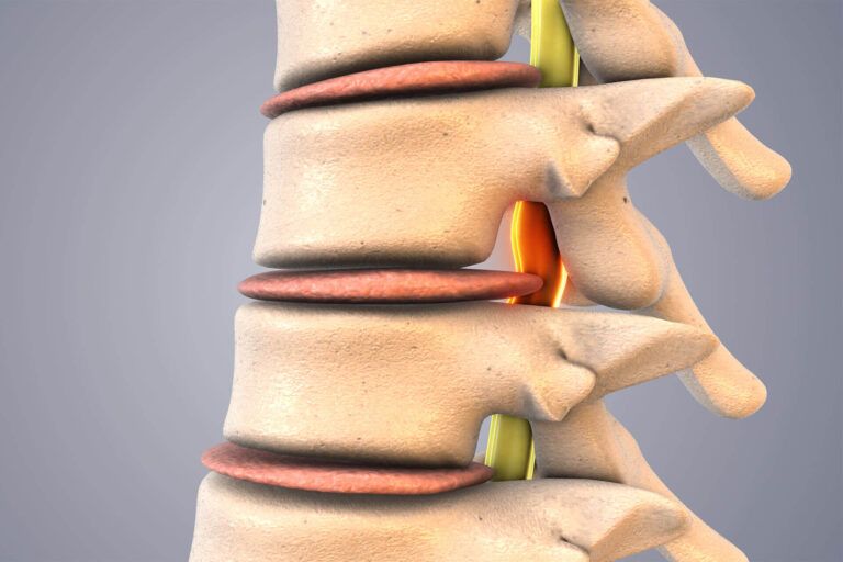 Spinal Decompression Therapy Explained in Medical Animation 3d illustration