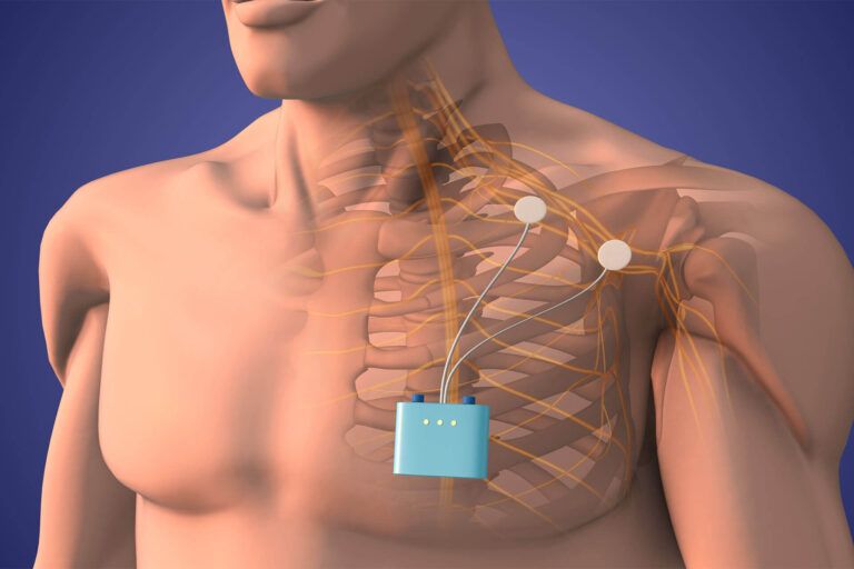Peripheral nerve stimulation therapy in shoulder area 3D Illustration