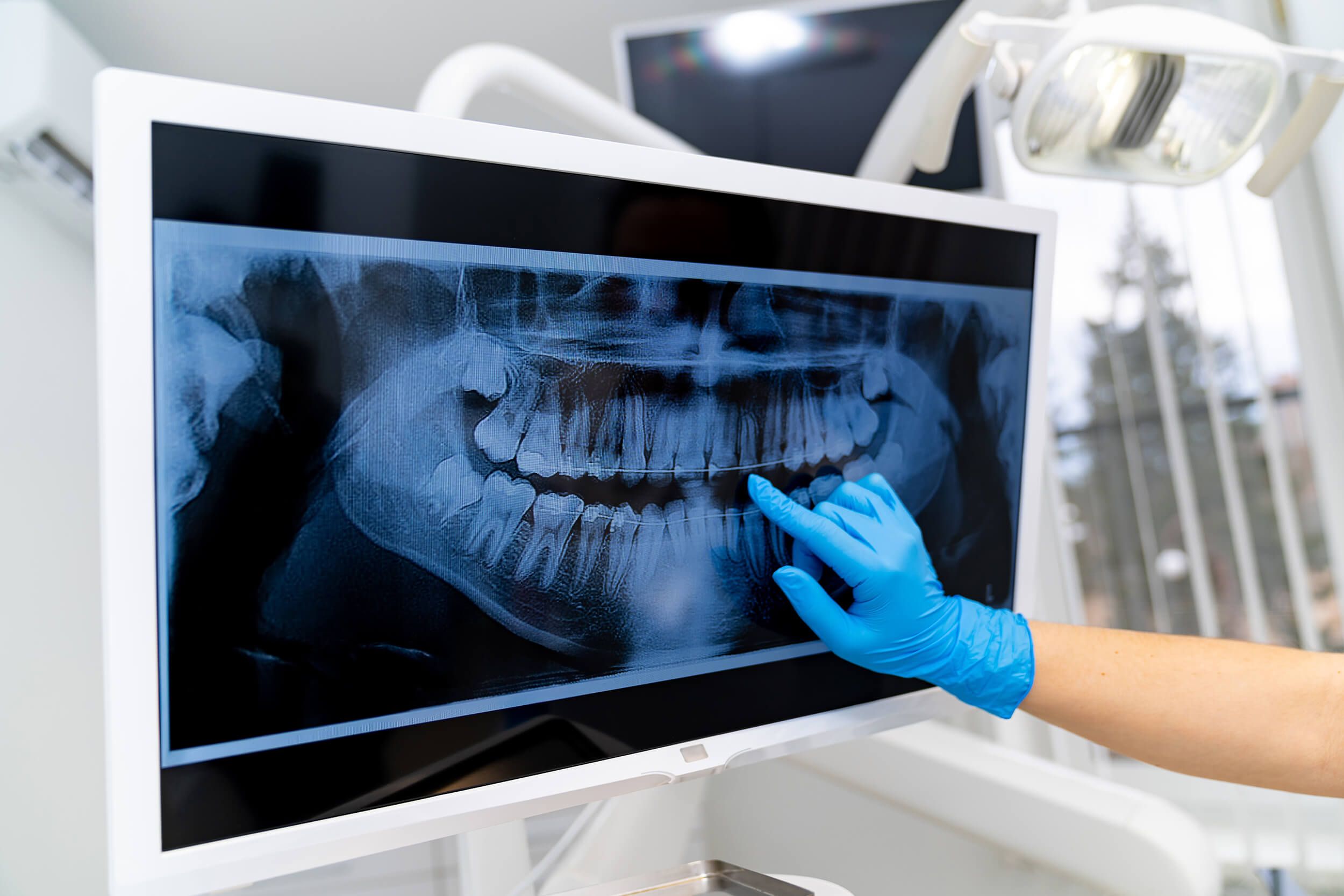 a dental panoramic x-ray being reviewed by a dental professional on a computer monitor.