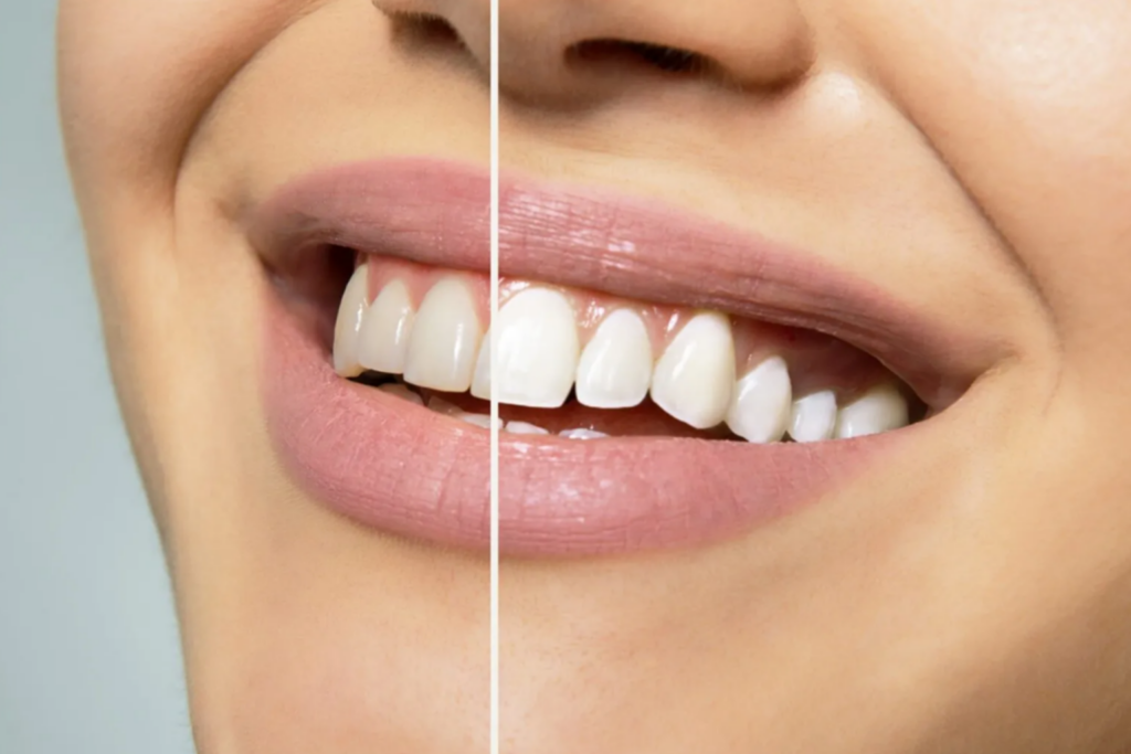 Teeth-Whitening
