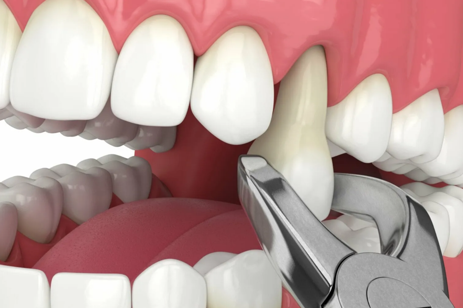 Tooth-Extractions