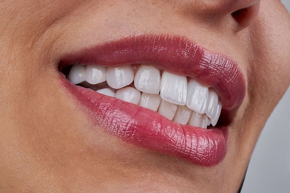 Porcelain Veneers