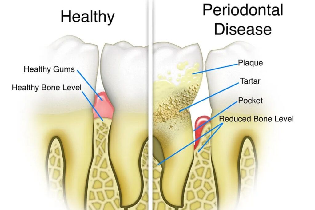 Periodontal Disease