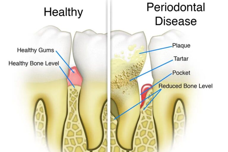 Periodontal Disease