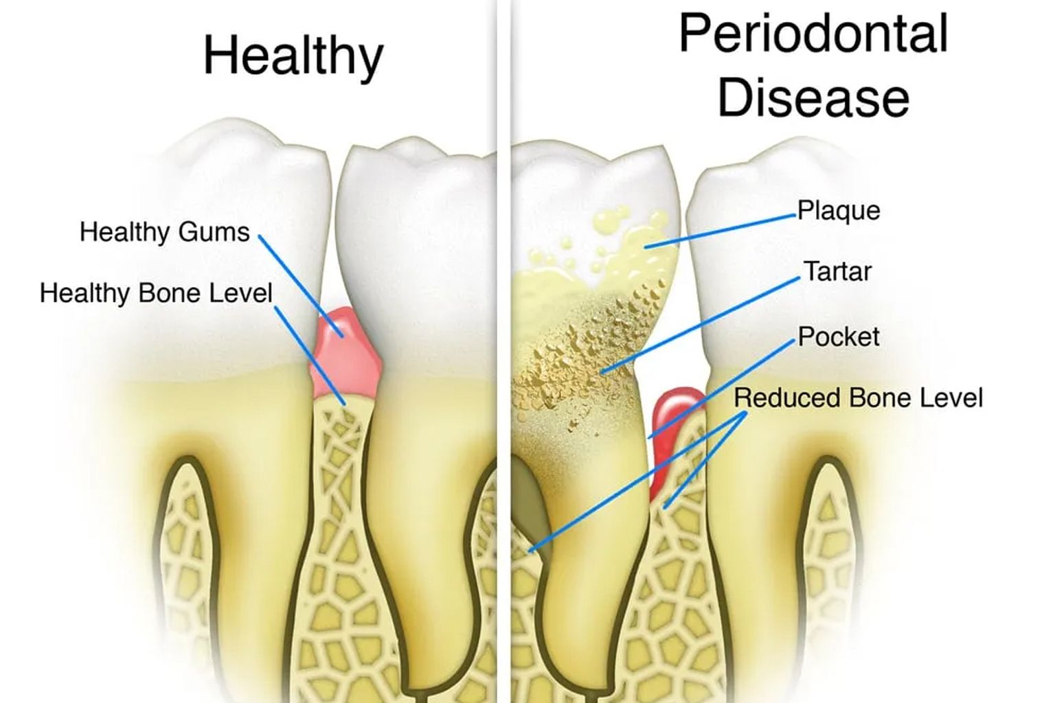 Periodontal Disease