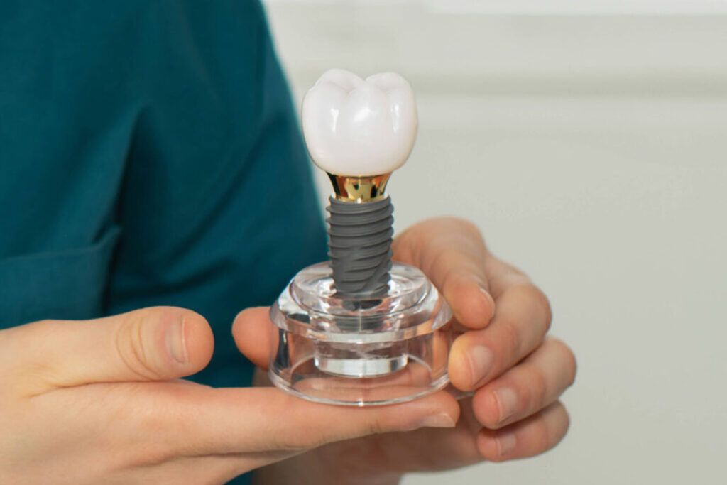 Dental Implants