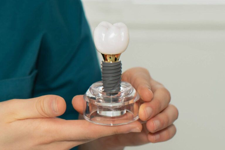 Dental Implants