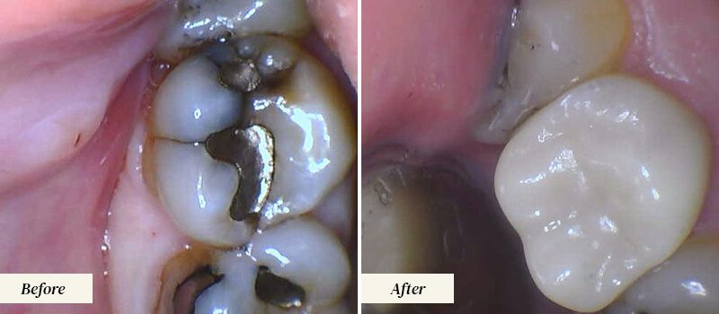 Boynton Dentist Before and After