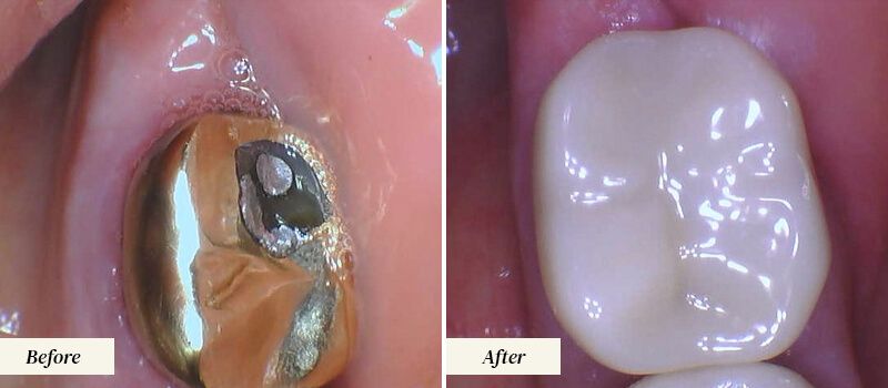 Dental Crowns Before and After