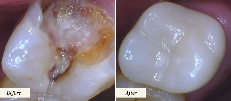 Root Canal Therapy Before and After