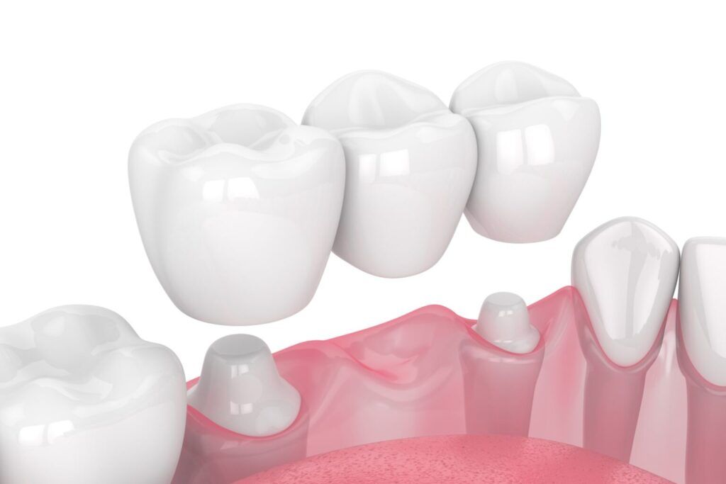 Dental Crowns