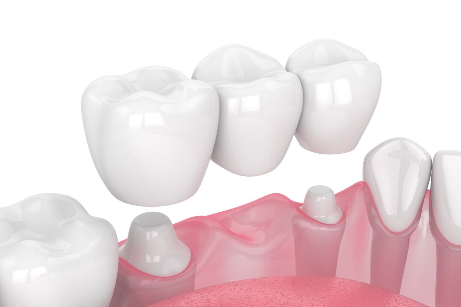 Dental Crowns