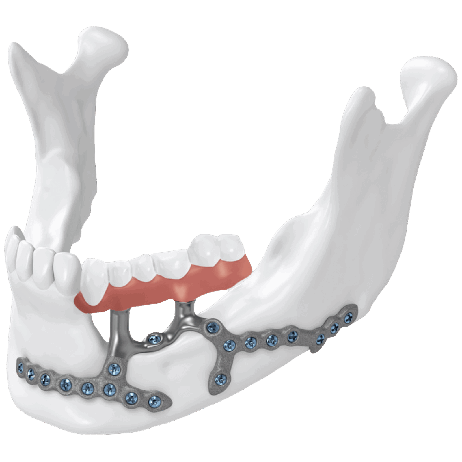 Marginal Mandibular Resections