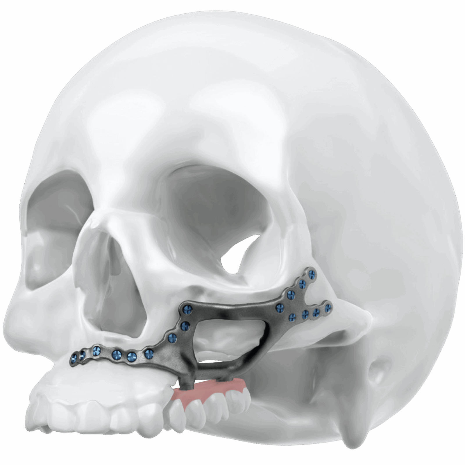 Maxillary Resections