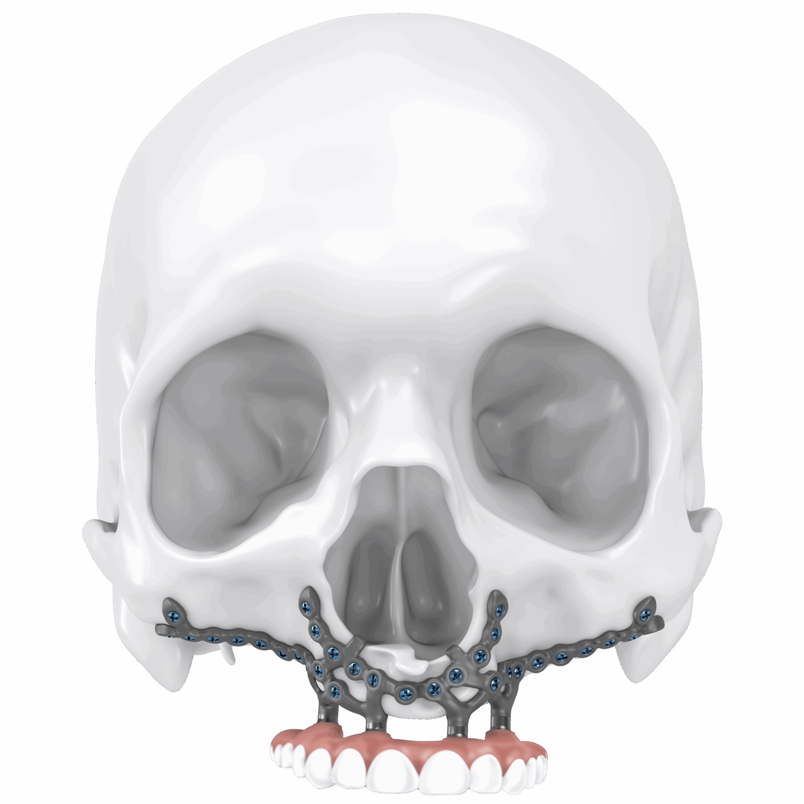 a custom-designed, 3D-printed subperiosteal implant used for maxillofacial rehabilitation.