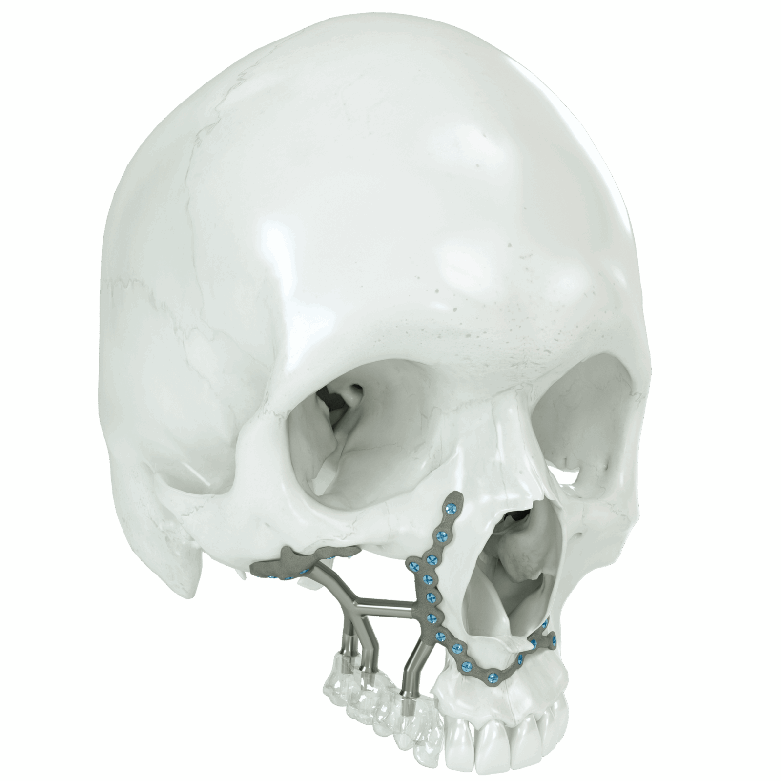 a custom-designed bone-based framework for dental rehabilitation.