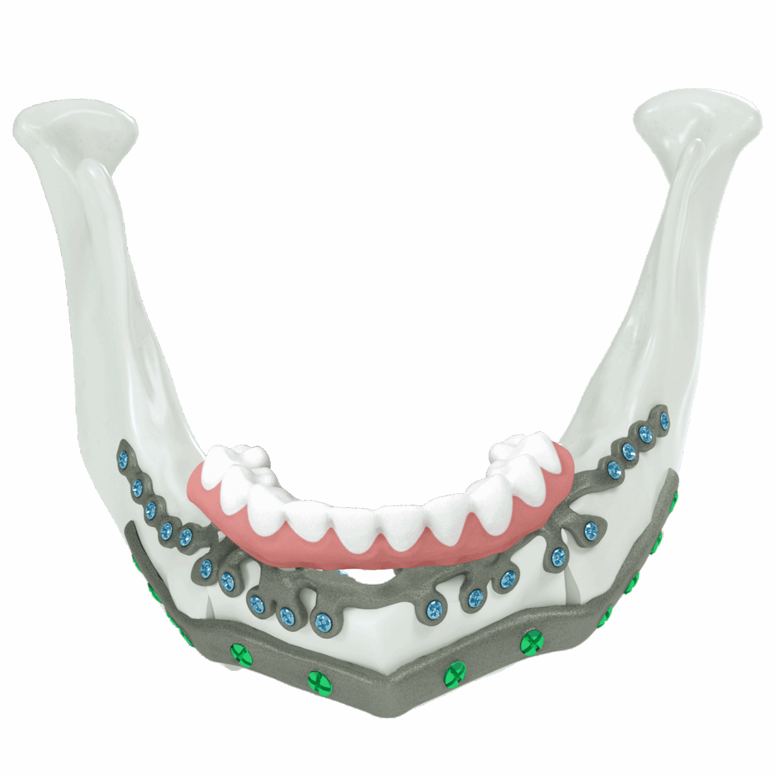 KLS Martin Group IPS Implants® Preprosthetic for mandibular reconstruction.
