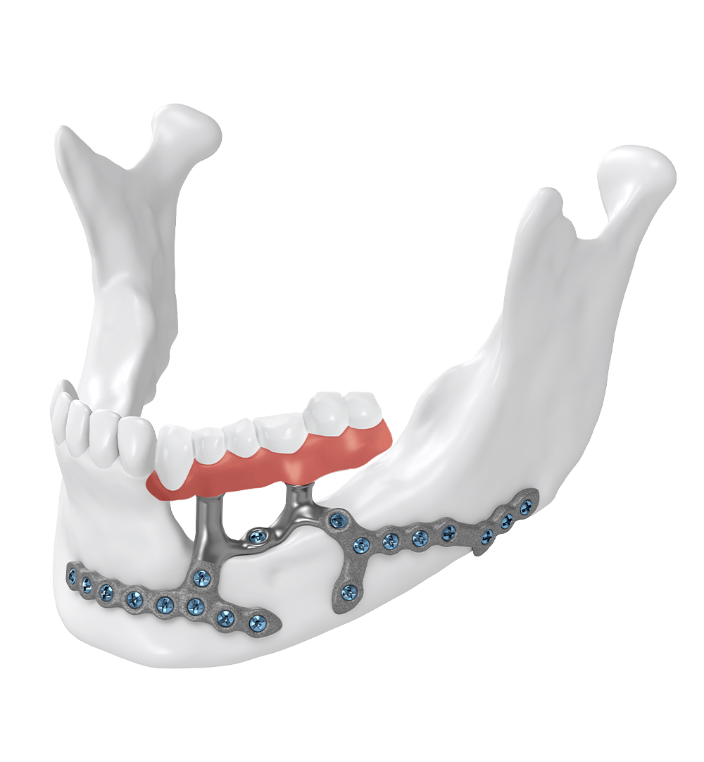 casestudies-Marginal Mandibular Resections