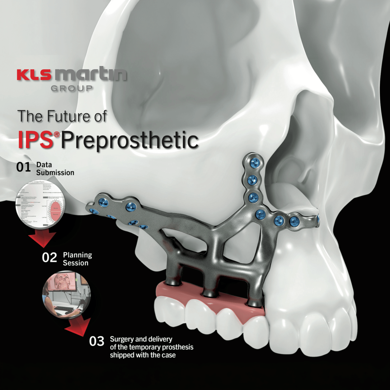 IPS Preprosthetic Bundle Announcement Flyer