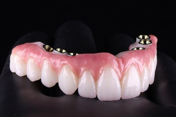 custom final prosthesis