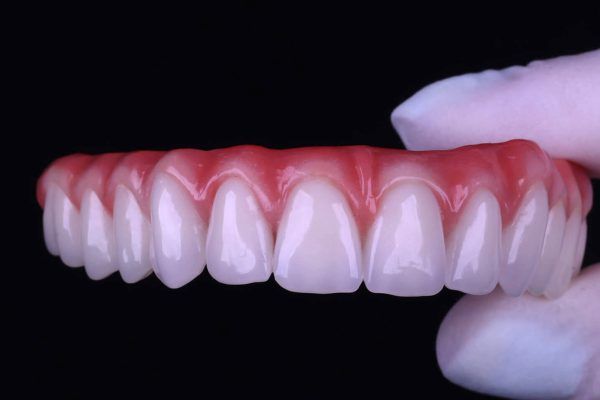 custom final prosthesis