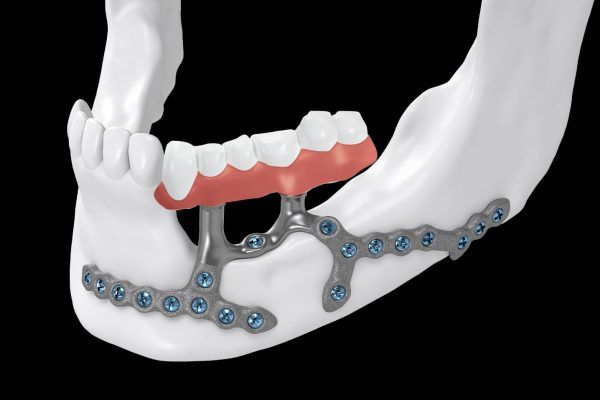 KLS Martin | IPS Implants® Mandible Reconstruction
