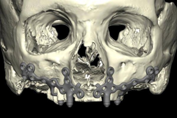 Engineers and surgeons virtually model a device using CAD