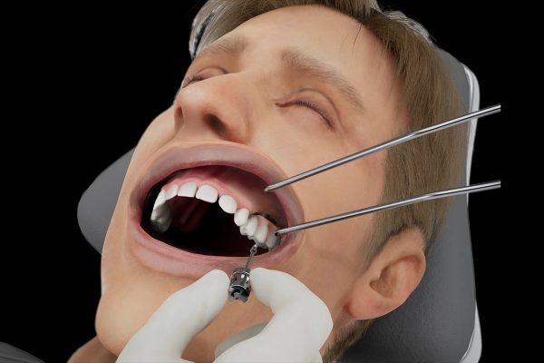 A pre-manufactured temporary prosthesis being attached to framework