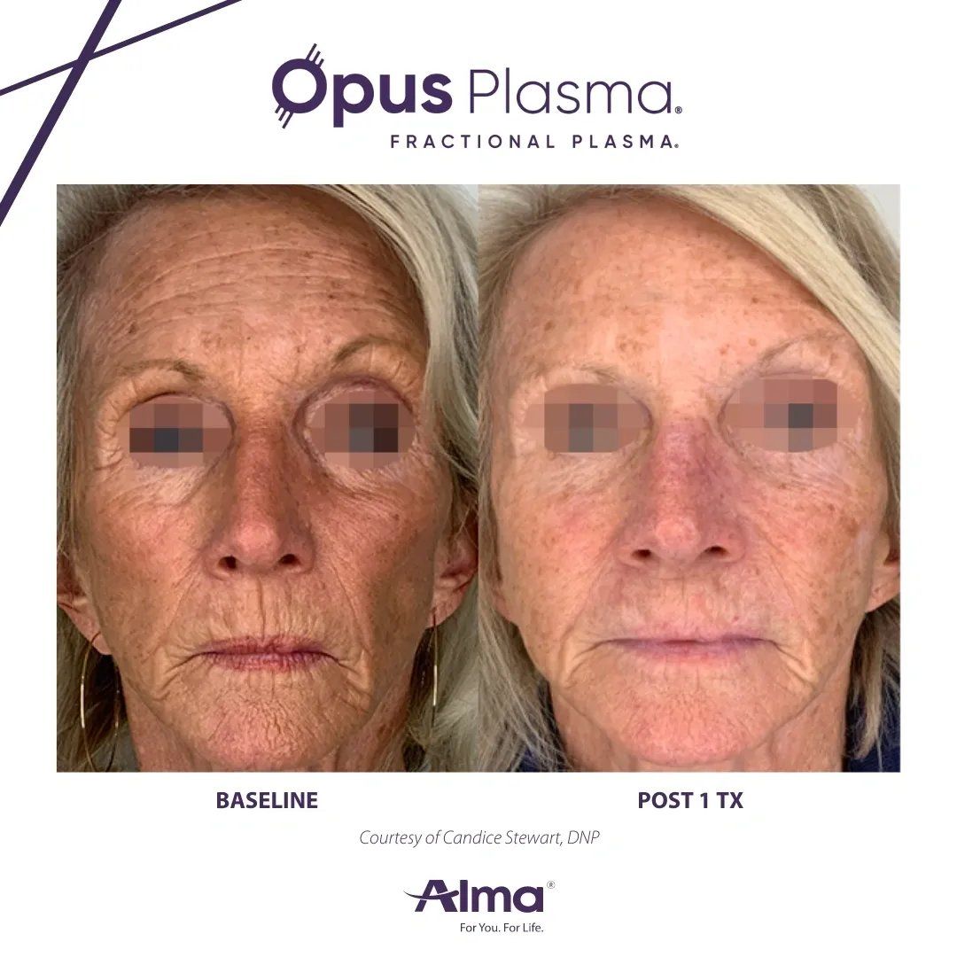 Patient Before & After treatment
