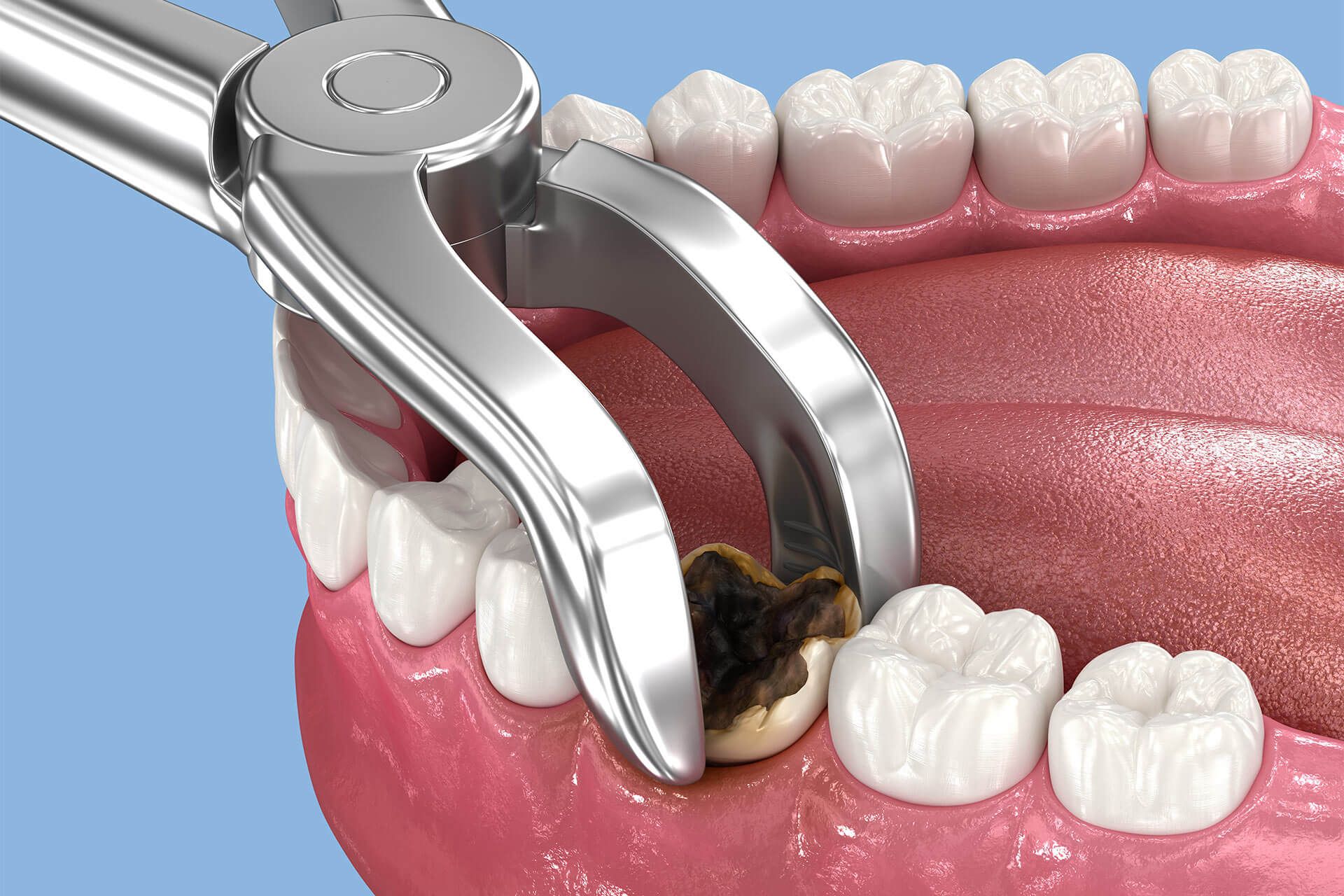 Tooth Extractions - Keystone Dentistry - Bethlehem, PA