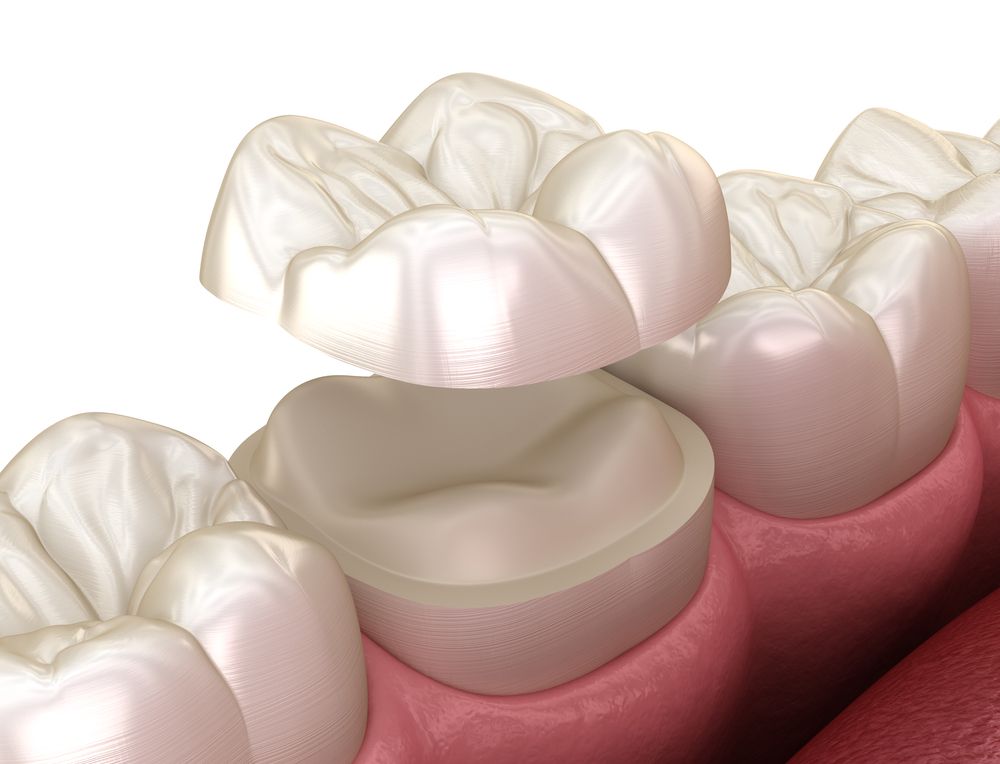 Inlays and Onlays | Norwood & New Bedford | New England Dental ...