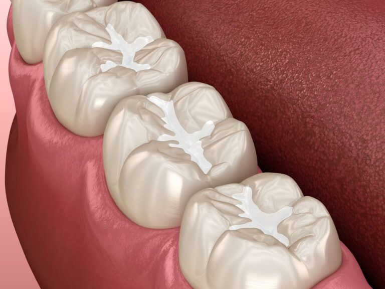 Molar Fissure dental fillings, Medically accurate 3D illustration of dental concept