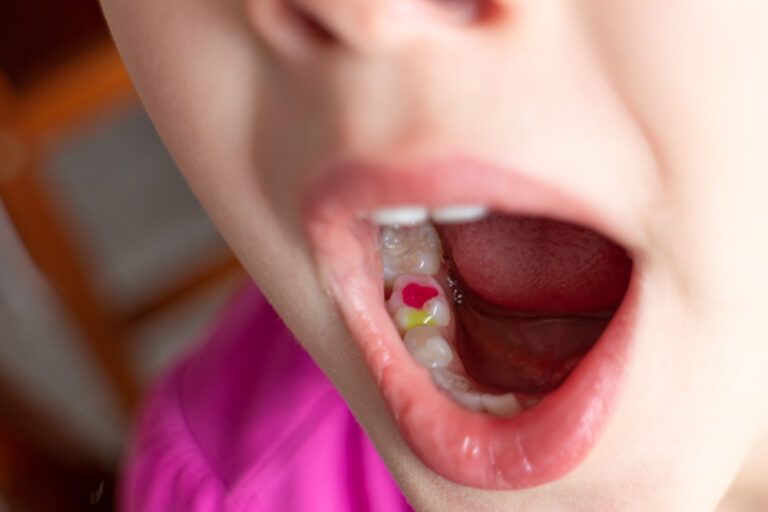 A girl showing her colorful filling in milk teeth.