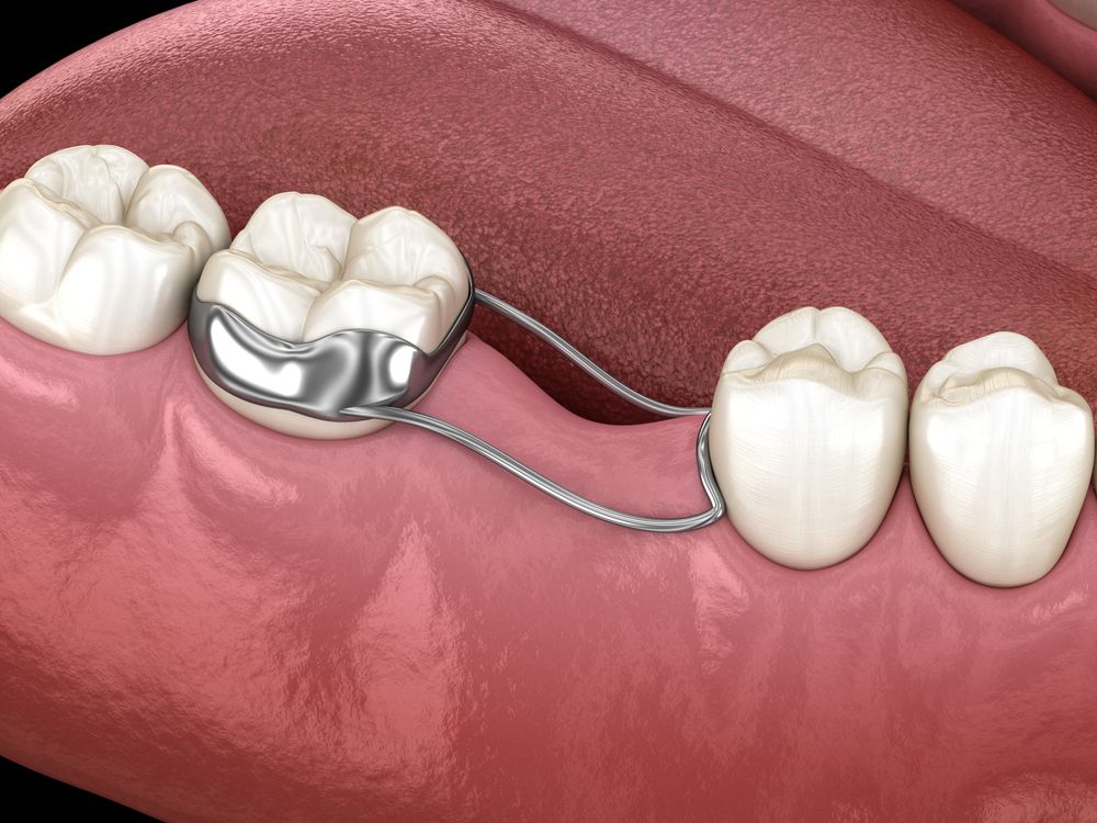 Space Maintainer Unilateral keeps from teeth shift deformation after losing molar tooth