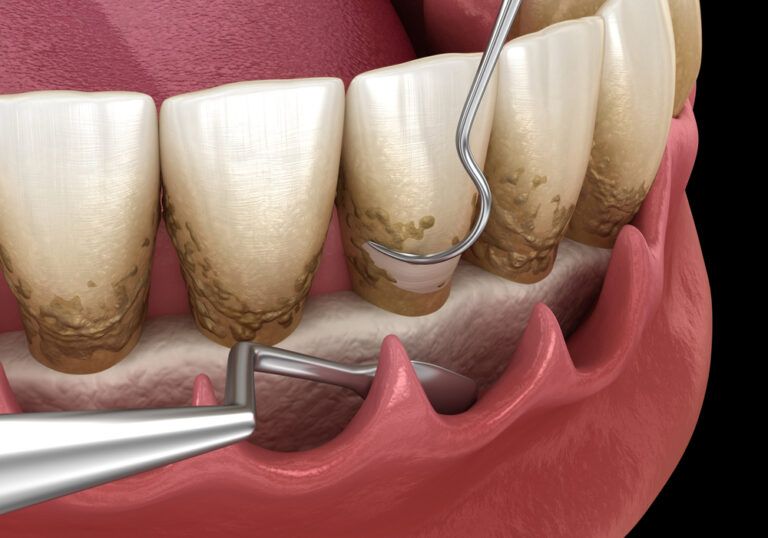 Open curettage: Scaling and root planing (conventional periodontal therapy).