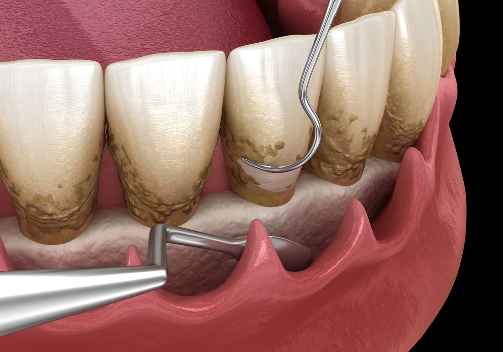 Open curettage: Scaling and root planing (conventional periodontal therapy).