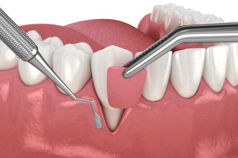 Gum Recession: Soft tissue graft surgery. 3D illustration of Dental treatment
