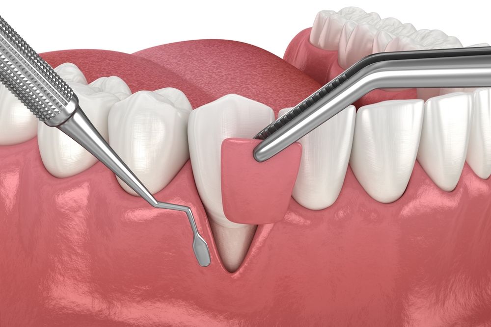 Gum Recession: Soft tissue graft surgery. 3D illustration of Dental treatment