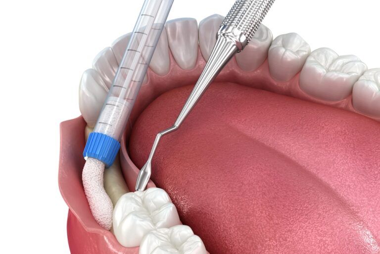 Bone grafting augmentation for tooth implantation. Medically accurate 3D illustration.