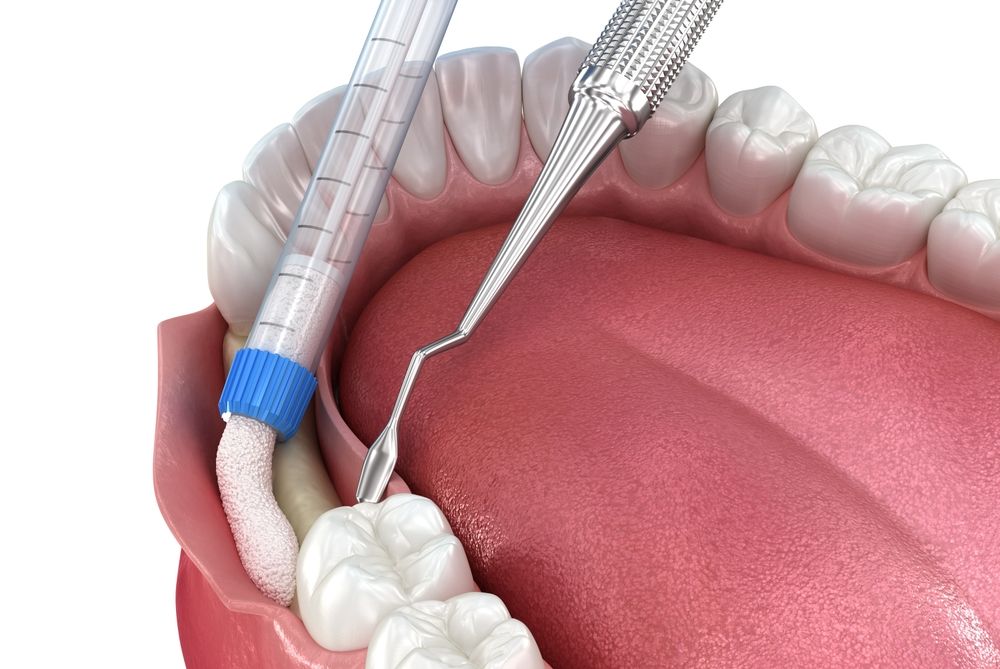 Bone grafting augmentation for tooth implantation. Medically accurate 3D illustration.