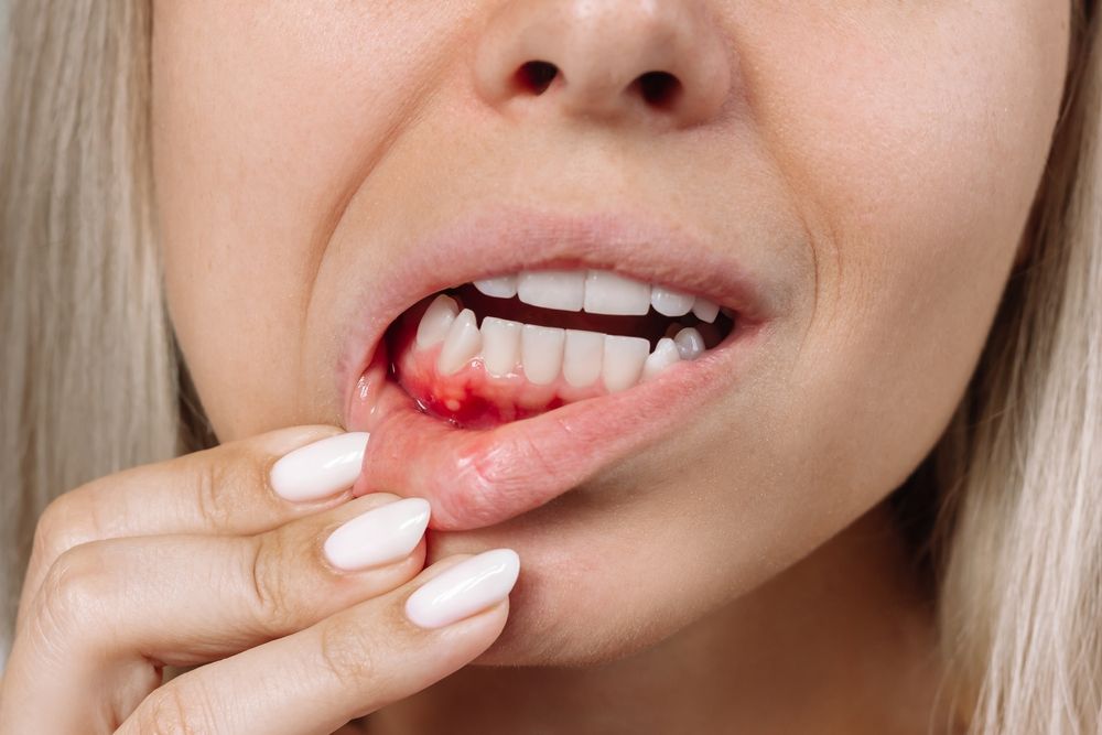 Ulcerative stomatitis on the gums. Gum inflammation.