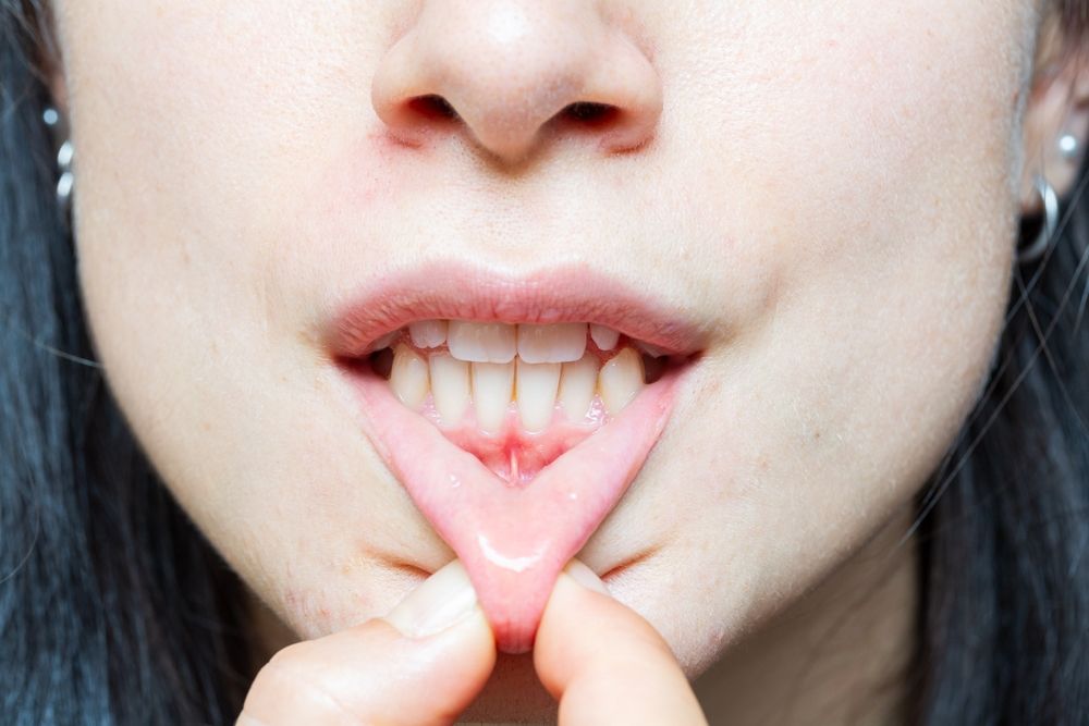 condition of gum recession, where the margin of the gum tissue surrounding the teeth