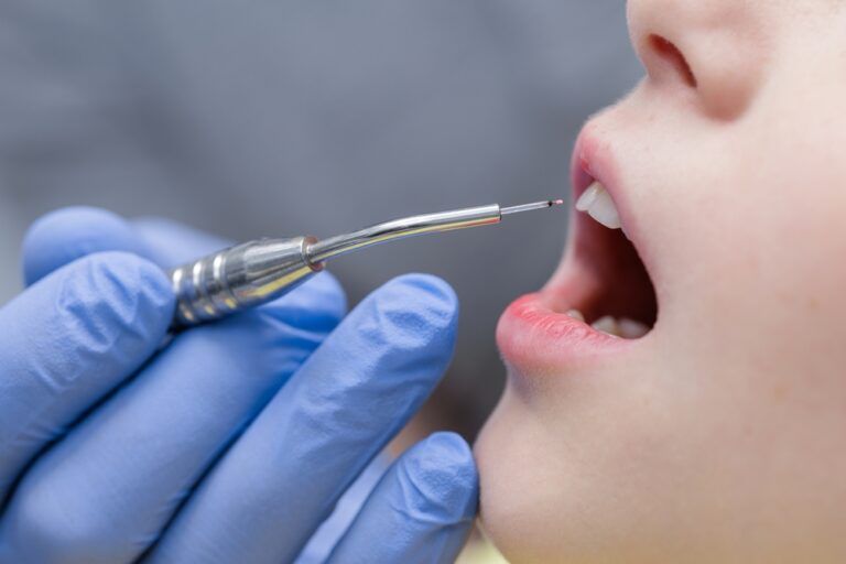 Close up of a diode laser tip near a child’s mouth during pediatric dental treatment,
