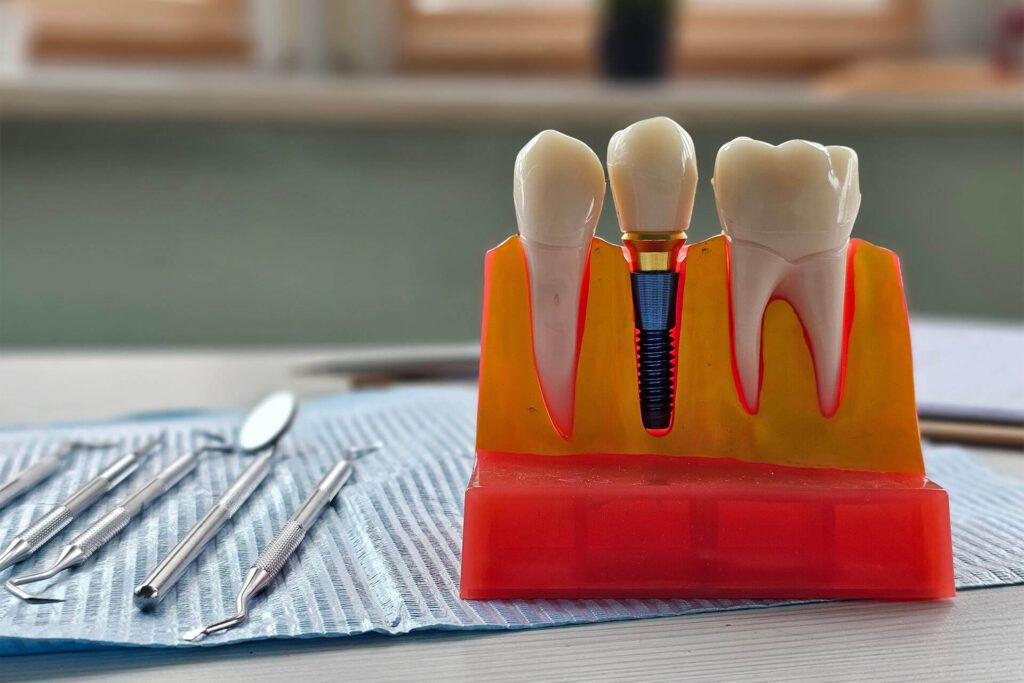 Dental model demonstrating implant procedure with tools on a table in a bright treatment room